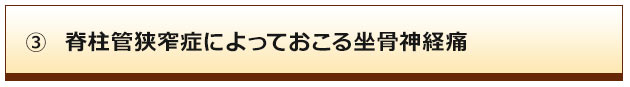 脊柱管狭窄症によっておこる坐骨神経痛